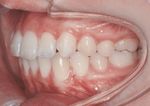 Skelettale Verankerung in der lingualen Orthodontie bei einseitiger Molarenextraktion