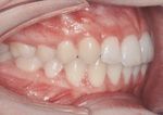 Skelettale Verankerung in der lingualen Orthodontie bei einseitiger Molarenextraktion