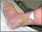 Varikosis und chronisch venöse Insuffizienz III - Ulcus cruris venosum - Klinik und ...