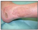 Varikosis und chronisch venöse Insuffizienz III - Ulcus cruris venosum - Klinik und ...