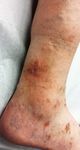 Varikosis und chronisch venöse Insuffizienz III - Ulcus cruris venosum - Klinik und ...