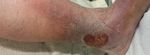 Varikosis und chronisch venöse Insuffizienz III - Ulcus cruris venosum - Klinik und ...