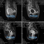 Friedrich Gill HIFU - die Zukunft der nichtinvasiven Myom- und Adenomyosetherapie? - Prof. MR. Dr. Friedrich Gill