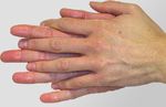 Hygienemaßnahmen bei Hand-Fuß-Mund-Krankheit (HFMK)