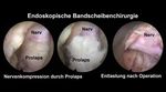 Endoskopische Bandscheibenoperation - Hals-, Brust- und Lendenwirbelsäule - der schnelle Weg zurück zur Aktivität und Sport - Klinik Sanssouci ...