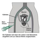 Behandlung von Myomen der Gebärmutter - Therapie mittels Embolisation - Kantonsspital St ...