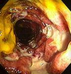 Nahrungsmittel-Allergien-Nahrungsmittel-Intoleranzen - Labors.at