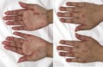 Update : Lupus und Sj&ouml;gren - Prof.M.Seitz RIA Universit&auml;tsklinik f&uuml;r Rheumatologie, Immunologie und Allergologie