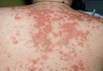 Update : Lupus und Sj&ouml;gren - Prof.M.Seitz RIA Universit&auml;tsklinik f&uuml;r Rheumatologie, Immunologie und Allergologie
