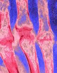 Rheumatoide Arthritis: aktuelle Therapie - Österreichische Ärztezeitung