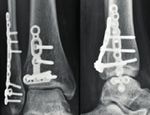 Ankle Trauma-System 2.8 / 3.5 - APTUS Ankle - PRODUK TINFORM ATION - Medartis
