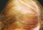 Mit selbstaufl ösenden Fäden gegen Haarausfall - ZWP online