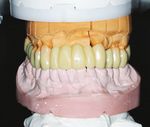 Zahnfarbene Kunststoffe als Gerüstmaterialien bei abnehmbarem Zahnersatz - ePaper
