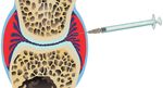 Radiosynoviorthese Patienteninformation - Curium Pharma