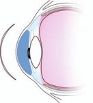 Grundlagen der Kontaktlinsen-Praxis - Teil 7 - Anpassung weicher torischer Kontaktlinsen - Johnson & Johnson