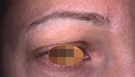 Entfernung von Permanent- Make-up mit Laser - FORTBILDUNG