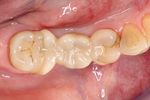Replacement of a missing molar despite proximal undercuts by using two single-retainer resin-bonded fixed dental prostheses Ersatz eines fehlenden ...