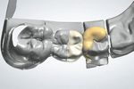 Replacement of a missing molar despite proximal undercuts by using two single-retainer resin-bonded fixed dental prostheses Ersatz eines fehlenden ...