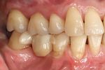 Replacement of a missing molar despite proximal undercuts by using two single-retainer resin-bonded fixed dental prostheses Ersatz eines fehlenden ...