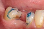Replacement of a missing molar despite proximal undercuts by using two single-retainer resin-bonded fixed dental prostheses Ersatz eines fehlenden ...