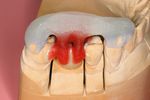 Replacement of a missing molar despite proximal undercuts by using two single-retainer resin-bonded fixed dental prostheses Ersatz eines fehlenden ...