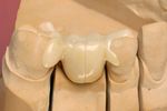 Replacement of a missing molar despite proximal undercuts by using two single-retainer resin-bonded fixed dental prostheses Ersatz eines fehlenden ...