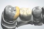 Replacement of a missing molar despite proximal undercuts by using two single-retainer resin-bonded fixed dental prostheses Ersatz eines fehlenden ...