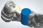 Replacement of a missing molar despite proximal undercuts by using two single-retainer resin-bonded fixed dental prostheses Ersatz eines fehlenden ...