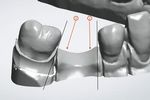 Replacement of a missing molar despite proximal undercuts by using two single-retainer resin-bonded fixed dental prostheses Ersatz eines fehlenden ...