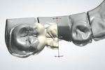 Replacement of a missing molar despite proximal undercuts by using two single-retainer resin-bonded fixed dental prostheses Ersatz eines fehlenden ...