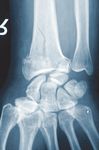 Distale Radius- und Ulnaplatten 2.5 Operationstechnik - aap ...