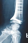 Distale Radius- und Ulnaplatten 2.5 Operationstechnik - aap ...