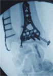 Distale Radius- und Ulnaplatten 2.5 Operationstechnik - aap ...