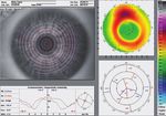 Gut schlafen mit Kontaktlinsen - gut sehen ohne Sehhilfe: Orthokeratologie