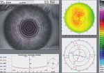 Gut schlafen mit Kontaktlinsen - gut sehen ohne Sehhilfe: Orthokeratologie