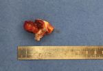 Kopfschmerzen und arterielle Hypertonie - Herr D, 48-j&auml;hrig