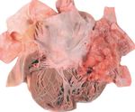 Kopfschmerzen und arterielle Hypertonie - Herr D, 48-j&auml;hrig