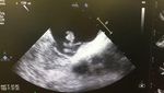 Kopfschmerzen und arterielle Hypertonie - Herr D, 48-j&auml;hrig