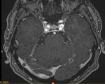Kopfschmerzen und arterielle Hypertonie - Herr D, 48-j&auml;hrig