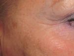 Duetto MT EVO Serie - ÄSTHETIK & DERMATOLOGIE - Asclepion Laser Technologies