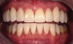 Digitales Smile Design: Sieben Veneers an einem Tag - ePaper