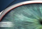 BEIM KAMPF UMS AUGEN LICHT: Moderne Methode der Glaukombehandlung - Presseinformation - Augenzentrum Eckert