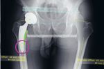 Kurzschaftprothesen für junge Patienten: Knochen-sparen ohne Risiko?