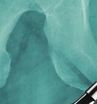 Kurzschaftprothesen für junge Patienten: Knochen-sparen ohne Risiko?