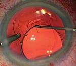 Kataraktchirurgie - patientengerechte Implantate - Das Auge war das Organ, womit ich die Welt fasste", Johann Wolfgang von Goethe (1749 -1832) ...