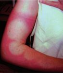 SGDV Nationale Hautkrebskampagne 2019: Mediendossier - "FAQ's" zur UV-Strahlung / Sonnenschutz - Derma.ch