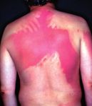 SGDV Nationale Hautkrebskampagne 2019: Mediendossier - "FAQ's" zur UV-Strahlung / Sonnenschutz - Derma.ch