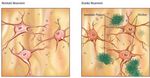 Ursachen und Symptome von Demenz - Jahresarbeit von Lena Binning Fach: Biologie Fachlehrer: Herr Stehl Hessisch Lichtenau/ Friedrichsbr&uuml;ck, den ...