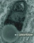 Ursachen und Symptome von Demenz - Jahresarbeit von Lena Binning Fach: Biologie Fachlehrer: Herr Stehl Hessisch Lichtenau/ Friedrichsbr&uuml;ck, den ...