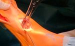 Lapidus Arthrodese TMT I - OP-Technik mit Shark Screw - Surgebright
